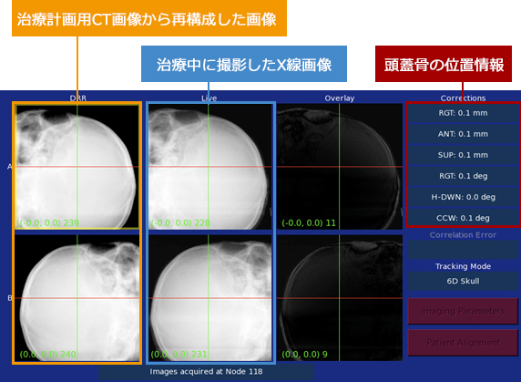 頭蓋骨追尾システム図