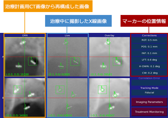 治療中の位置情報解析画面